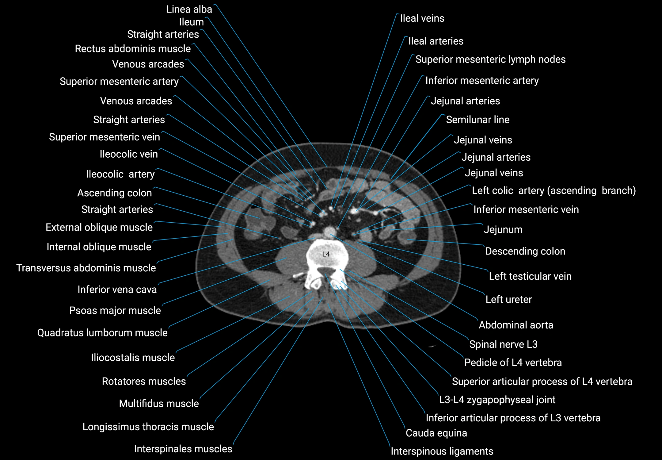 CT male pelvis axial cross sectional anatomy labelled radiology image -00103.webp